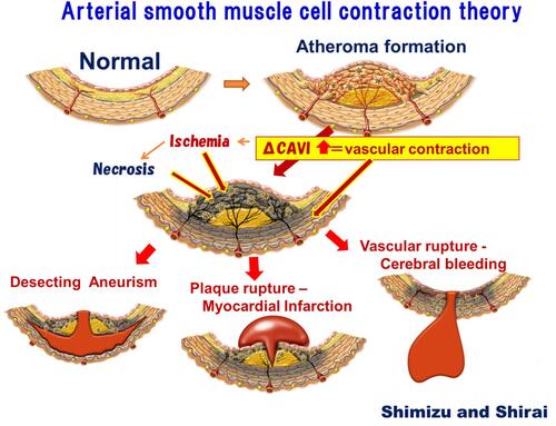 Figure 5 “Smooth muscle cell contraction” hypothesis for plaque rupture.