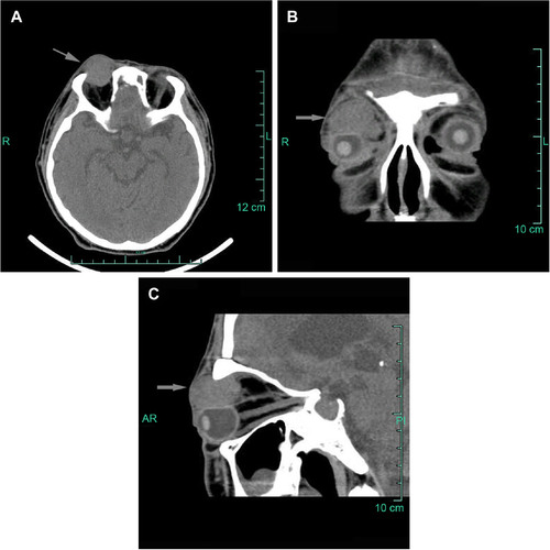 Figure 1 Computed tomography scans showing a homogeneous, isolated, ill-defined soft tissue density mass in the right orbit (A–C; arrows). The right eyeball was displaced anteriorly and inferiorly. (A) Axial section, (B) sagittal section, and (C) coronal section.