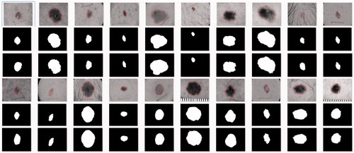 Figure 6. The graph contains 20 melanoma image segmentation results. The first and fourth rows are the result of the segmentation of the 20 melanoma images using the improved CNN, the lesion area is circled with the red line; the second and fifth rows are the mask of the test image segmentation; the third and sixth rows are Experts’ manual segmentation, ie ground truth mask. The results of the test segmentation are compared with the ground truth.