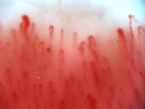 Figure 5 Capillaroscopy – nonspecific pattern, with dilated vessels.