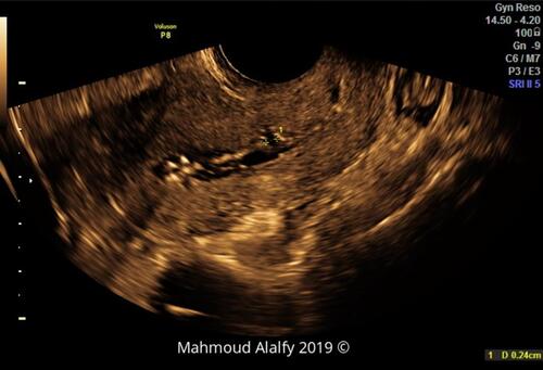 Figure 4 2D SHG image in a sagittal section of the uterus showing the cesarean scar niche BW.