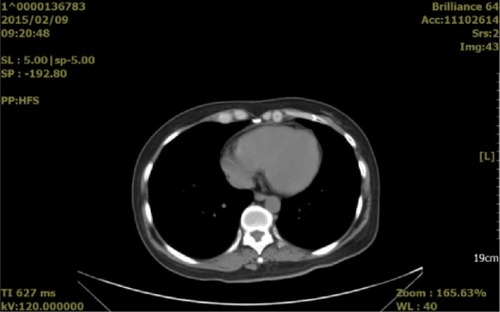 Figure 2 Pericardial effusion-volume changes seen on a computed tomography image obtained on February 9, 2015 (2 months after bevacizumab treatment).