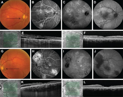 Figure 1 Multimodal imaging of a 71-year-old male patient with severe bilateral chronic central serous chorioretinopathy (A–F: right eye, G–L: left eye).