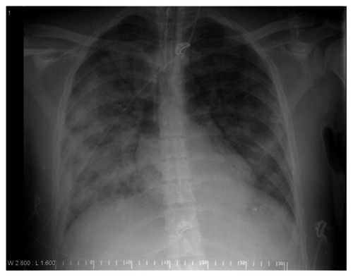 Figure 2 Chest X-ray displaying opacities consistent with acute respiratory distress syndrome (ARDS).