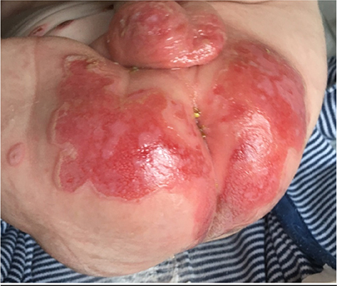 Figure 5 Chronic nappy wound on an infant with JEB-GS.