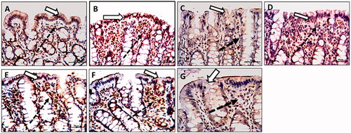 Figure 6. Olmesartan medoxomil self-microemulsifying drug delivery system (OMS) nanoformulation improves apoptosis in trinitrobenzene sulfonic acid (TNBS)-induced acute colitis in rats. Photomicrographs of colonic sections showing immunoexpression of caspase-3 in surface epithelium (white arrows) and underlying lamina connective tissue cells (dotted arrows) (× 20): (A) Normal control group showed a faint reaction. (B) TNBS-colitic (Positive control) group showed a strong reaction with a marked increase of the positively stained cells. (C) Sulfasalazine and (G) Olmesartan medoxomil self-microemulsifying drug delivery system high dose groups showed marked improvement with a marked decrease in the number of the positively stained cells (D) Olmesartan medoxomil low dose group revealed mild improvement. (E) Olmesartan medoxomil high dose and (F) Olmesartan medoxomil self-microemulsifying drug delivery system low dose groups showed moderate improvement.