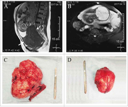 Figure 1. MRI and gross appearance of tumors. (A) MRI showing the dysgerminoma occupying the whole Douglas cul-de-sac. (B) MRI showing the desmoid tumor at the left side of uterus. (C) The right ovarian mass and fallopian tube after excision. (D) The retroperitoneal mass after excision.