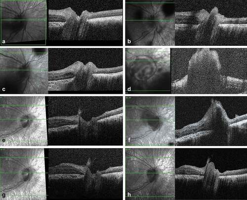 Figure 2. SD-OCT imaging of an optic nerve retinoblastoma relapse following an epipapillary seed implantation. (a) Scan of the optic disc at the end of the first-line treatment showing an intact optic nerve head. (b) Same imaging at time of the vitreous relapse showing an epipapillary seed filling the optic nerve cup. (c) Regression of the epipapillary seed after two intravitreal melphalan. (d) Massive relapse masking the optic nerve 2 months later, with no demarcation line between the anchored seed and the papilla. (e) Regression of the relapse after 2 intraarterial and 4 intravitreal injections with combined topotecan and melphalan. (d) New epipapillary growth with suspicion of prelaminar invasion four months later. (g) Regression of the relapse after two cycles of combined intra-arterial melphalan and topotecan. (h) Infraclinical optic nerve head recurrence 6 months later motivating secondary enucleation.