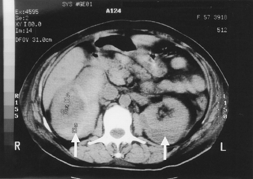 Figure 1. CT showing bilateral perinephric hematoma (arrow).