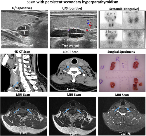 Figure 2 Secondary hyperparathyroidism in a 56-year-old dialysed patient. A dual-phase 99m Tc-MIBI imaging was nonlocalizing, MRI and high-resolution ultrasonography was both suggestive of five enlarged parathyroid glands. 4D-CT revealed a 1.3 cm retroesophageal parathyroid adenoma posterior to the cricoid cartilage, located superior the right thyroid glands (an arrow). Even the left inferior parathyroid gland, which was the smallest in size and weight, was found during surgery and hyperplastic parathyroid gland was verified by postsurgical histology in all lesions. PTH serum levels decreased from 170 pg/mL preoperatively to 24 pg/mL on the day after surgery.