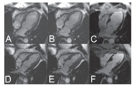 Figure 3 MR Imaging of a 64 year old male before (top line) and after (bottom line) 3-fold CABG. SSFP Cine images in enddiastole (A) and endsystole (B) reveal the severely impaired global LV function before surgery (EF 30%) with akinesia in the apical inferoseptal and anterolateral wall and the apex (segments 14, 16, and 17) and hypokinesie in the basal and mid-ventricular lateral wall. The contrast-enhanced TurboFLASH image (C) shows broad subendocardial late enhancement (bright signal) in the apical septum, thin LE in the lateral wall and transmural LE in the apex meaning chronic scar. LV function after surgery (D, E) shows no improvement in the apical septum and the apex, whereas the complete lateral wall improved and became normokinetic. No changes in scar extent (F). Global LV function improved to EF 40%, LV volumes decreased.