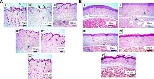 Figure 8 Histological examination (H&E, 100×) of rat-paw skin.Notes: (A) Thin skin and (B) thick skin. (I) Normal control showing normal picture, (II) positive control with detachment of epidermal layer (arrows) and severe dermal inflammatory reaction in thin skin (A, blue star), as well as severe inflammatory reaction in dermal and muscular layers in thick skin (B, blue stars), (III) rats orally pretreated with Dcn (100 mg/kg) showing moderate dermal inflammatory reaction in thin skin (A, blue star), moderate inflammatory reaction in dermal and muscular layers in thick skin (B, blue stars), (IV), (V) rats pretreated with 1:10 Dcn:Glc SNEDDSs or 1:8 Dcn:TPGS SNEDDS, respectively, exhibiting skin nearly retained its normal picture.Abbreviations: Dcn, diacerein; Glc, gelucire 44/14; TPGS, d-α-tocopheryl polyethylene glycol 1,000 succinate; SNEDDS, self-nanoemulsifying drug-delivery system.