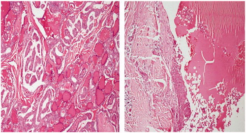 Figure 3. Histopathological picture showing papillary carcinoma in the wall of thyroglossal cyst.