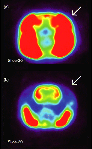 Figure 1.  Representative transverse slices showing glucose uptake in the head of rats that chewed a wooden stick during IMO stress (a) without or (b) with the pretreatment injection of botulinum toxin type A into the temporalis muscle (indicated by arrows to the right side). Intensity of SUV is shown in a pseudocolor scaling using MIPAV software package (red-to-blue indicates high-to-low accumulation of glucose, respectively). Note the clear picture of the brain of the chewing rat after blocking of the temporalis muscle in (b).