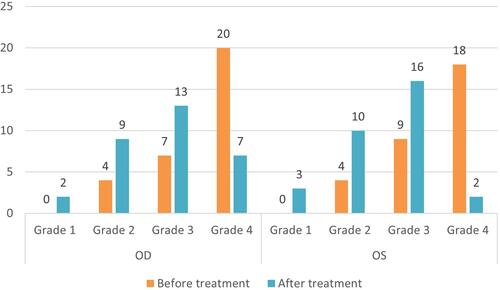 Figure 3 Meibograph grades before and after BBL-IPL therapy. Meibograph grades (1 to 4) were assigned based on the severity of meibomian gland dropout in the upper eyelids only. A higher grade represents increased severity.