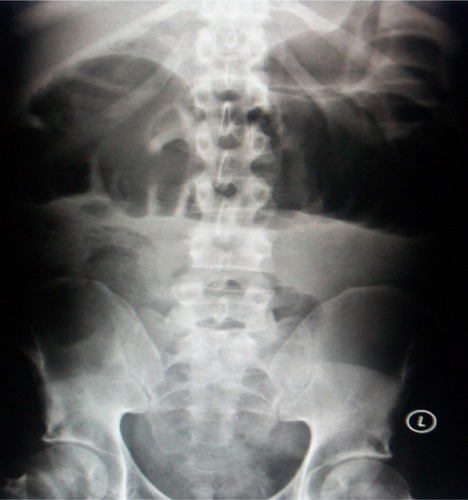 Figure 1 Abdominal X-ray on presentation demonstrating dilated large bowel loops.