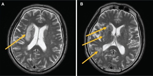 Figure 2 Axial T2-weighted magnetic resonance imaging (MRI) of the body of the lateral ventricle showing infarction of the right corona radiata, without major brain infarction in the left hemisphere.