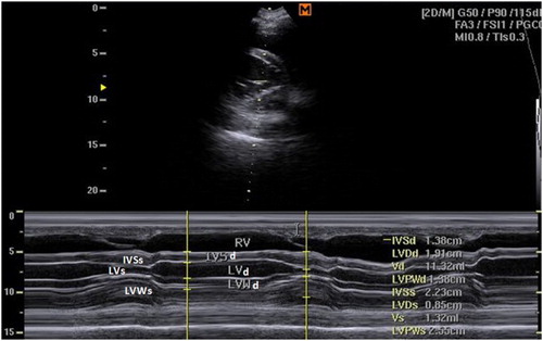 Figure 3. Right parasternal M-mode short-axis echocardiogram of small buffalo at the cordal (cordae tendinae) level showing IVSd, interventricular septal thickening in diastole; IVSs, interventricular septal thickening in systole; LVIDd, left ventricular internal diameter in diastole; LVIDs, left ventricular internal diameter in systole; LVWd, left ventricular wall thickness in diastole; LVWs, left ventricular wall thickness in systole.
