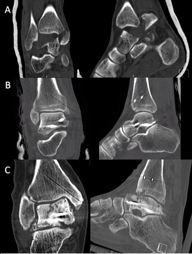 Figure 4. CT demonstrating a Hawkins type 3 fracture of the talus and associated medial malleolus fracture (A) in a 61-year-old man after a crush injury suffered during forest work. The fracture was treated with screw fixation (B), non-weight-bearing cast immobilization, and alendronate for 6 months. At 5.8 years after the surgery, the fracture had healed and the subchondral bone in the talar dome showed fragmentation due to collapse (C). Despite having poor ankle function (SEFAS of 12), the patient declined further surgery.