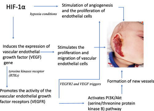 Figure 2 The VEGF – HIF-1α pathway in the appearance of hemangiomas.