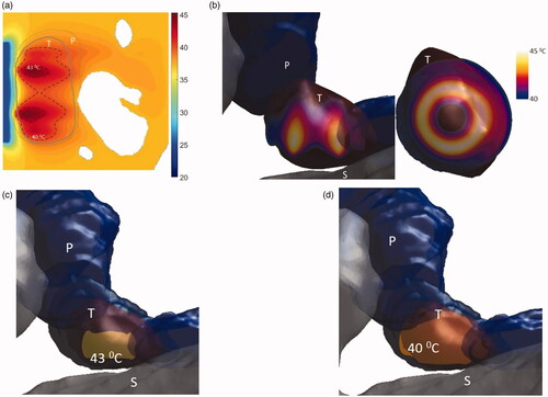 Figure 12. Simulated temperature distributions of endoluminal ultrasound hyperthermia directed at a pancreatic tumor (case III small body) using applicator geometry III (two 1 cm OD × 0.5 cm long transducers, 3.4 MHz, 3.6 cm balloon aperture): (a) temperature distribution with highlighted 40 and 43 °C contours across a central axial plane, with both tumor (T) and pancreas (P) delineated, (b) Temperature distribution across a central axial plane and a transverse plane at a depth of 6 mm from aperture surface overlaid with model anatomy, (c) 43 °C iso-temperature volume inside the target, and (d) 40 °C iso-temperature volume inside the target. P: pancreas, S: stomach, T: tumor.