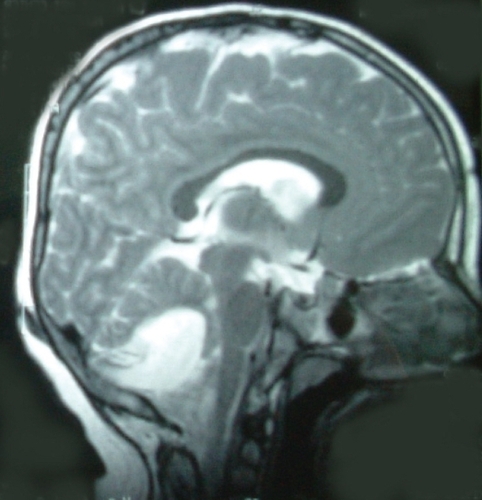 Figure 2 Brain magnetic resonance imaging (T2 weighted image, sagittal view) of case 2 demonstrates the occipital dermal sinus, inracranial sinus tract, and midline posterior fossa cystic mass.