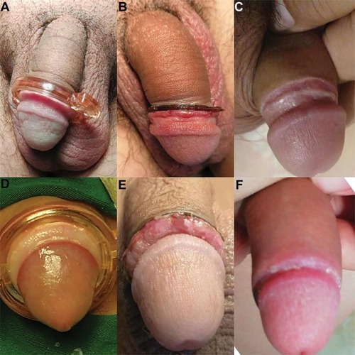 Figure 1 Normal process of circumcision with CSR. Wearing the CSR: adults (A) and children (D), the CSR removal: adults (B) and children (E) and wound healed: adults (C) and children (F).