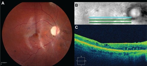 Figure 2 (A) Color fundus photograph of the right eye shows a clear view posteriorly with silicone oil present, sharp disc with 1+ pallor, normal vessels, flat macula, and periphery with preserved pigmentation and scattered focal areas of pigment clumping common after retinal detachment. (B) Five-line optical coherence tomography horizontal raster. (C) High-definition optical coherence tomography horizontal image shows preserved foveal contour, intact inner segment–outer segment junction, and trace intraretinal microcysts.