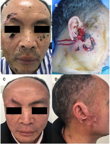 Figure 1 Main clinical manifestations. (A and B) Multiple plaques, maculopapules, atrophic scars with bulged edges and partial ulcerated skin lesions on his face; (C and D) Facial skin lesions after 8 sessions of 5-aminolevulinic acid photodynamic therapy.