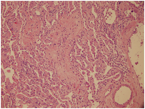 Figure 2 Lung biopsy showing bronchiolitis obliterans in the setting of chronic lung transplant rejection.