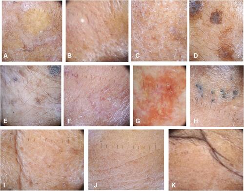 Figure 1 Dermoscopy photoaging scale findings. (A) yellowish discoloration, (B) yellowish papules, (C) white line/skin atrophy, (D) lentigo, (E) hypo-hyperpigmented macules, (F) telangiectasis, (G) actinic keratosis, (H) senile comedones, (I) deep wrinkles, (J) superficial wrinkles, (K) criss-cross wrinkles.