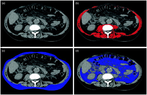 Figure 1. Example of a CT-analysis. (a) base CT-scan (b) total muscle area measurement (c) subcutaneous fat area measurement (d) visceral fat area measurement.