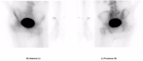 Figure 3 Bone scan showing no osteoblastic abnormality throughout the pelvis.