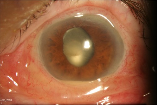 Figure 4 Endophthalmitis following intravitreal injection (note the chemosis and hypopyon).