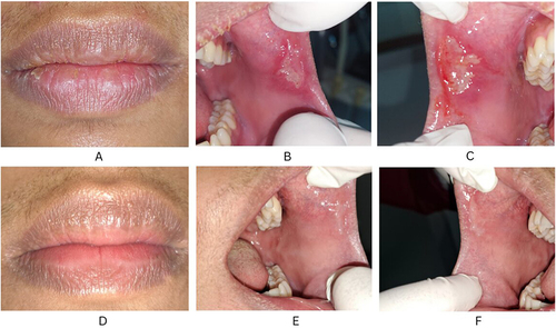 Figure 2 (a–c) Ulcer before treatment; (d–f). Oral cavity lesions resolved 3 weeks later (after treatment).
