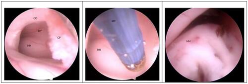 Figure 2 Endoscopic views in the surgery.
