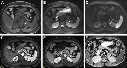Figure 2 A 65-year-old female with a pathologically proven, grade 1 neuroendocrine tumor in the pancreatic head.