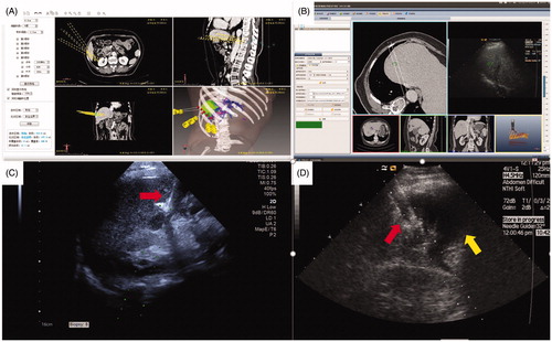 Figure 3. The four types of AATs were applied to assistance of US-PMWA for HCC lesions in CL. (A) A 65-years old, female patient had a HCC nodule (4.4 cm × 4.1 cm × 2.9 cm in diameter) located in S6 who underwent 3 D visualization preoperative planning; (B) A patient with HCC nodule (1.4 cm × 1.1 cm × 0.9 cm in diameter) located in S7 who under multimodal image fusion guided MWA; (C) A thermal monitoring needle was inserted the location abutting to the gallbladder (red arrow) for real-time temperature monitoring for the duration of ablation under US guidance; (D) The artificial ascites (yellow arrow) generated to separate the tumor from the hepatic capsule under US guidance during ablation procedure (red arrow).