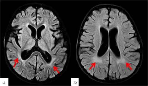 Figure 4. MRI brain Post neuro-toxicity. Selected axial FLAIR MR images (a, b) of the brain post chemotherapy demonstrate the development of the periventricular white matter changes (arrows) suggestive of the toxicity.