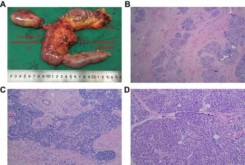 Figure 6 The postoperative specimen and histopathological result. (A) Postoperative specimen; (B) 4×10 magnification; (C) 10×10 magnification; (D) 20×10 magnification.