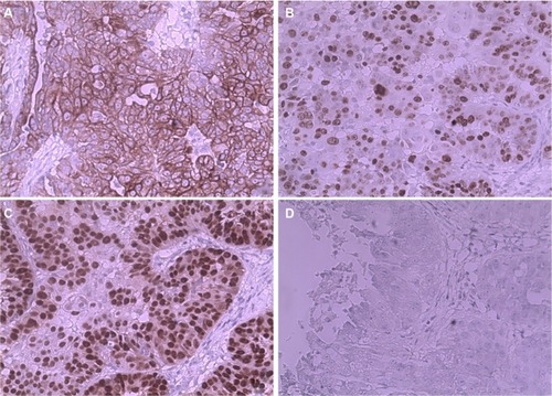 Figure 1 Immunohistochemistry revealed (A) CK(+++); (B) Ki-67(+++); (C) P53(+++); (D) Villin(−).