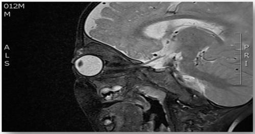 Figure 5 T2 weighted image, sagittal view of head and orbit, showing slightly homogenously enhanced lesion seen at superomedial aspect of left globe.