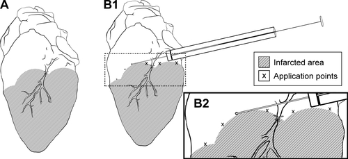 Figure S2 (A) Ischemic area resulting from left coronary ligation. (B1) and (B2) (blow-up), respectively: transplantation of NPC-ADMSC in the peri-infarcted area of the left ventricular wall.Abbreviations: NPC, curcumin-loaded polycaprolactone nanoparticles; ADMSC, adipose-derived mesenchymal stem cells.