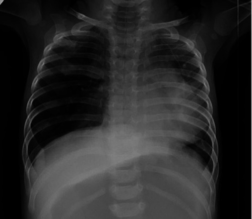 Figure 1 Chest X-ray showing overinflation in the right upper and middle zone, and mild shift of the mediastinum to the left.