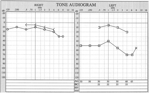 Figure 2. Preoperative audiogram of the patient.