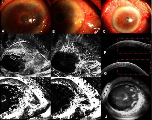 Figure 7 Anterior segment images of Case 6 in her right eye. (A) A gray white gelatinous tumor involving the nasal cornea and limbus with corneal edema (red arrow). (B) A gray white gelatinous tumor involving the nasal cornea and limbus with pterygium and corneal edema (red arrow); this is the same eye as that in A but from a different perspective. (C) The tumor partially resolved after treatment with only pterygium remaining (red arrow); the previous corneal edema disappeared. (D) Leakage from both the tumor and its feeding vessels was observed on FA results. (E) ICGA images showed both seafan-shaped intratumoral vessels and conjunctival feeding vessels clearly. (F) AS-OCT demonstrated a sharp delineation between normal and abnormal epithelia and a thickened and hyperreflective epithelium, as well as a plane of cleavage between the lesion and the underlying tissue (red dots). (G) AS-OCT results demonstrated that the neoplasm was partially resolved after treatment (red dots). (H) FA results showed that both tumor-related vessels and their leakage reduced partially. (I) Anterior segment ICGA results showed both iris vessels and tumor-related vessels, with the latter regressing to some extent. The number of residual vessels was reduced. (J) Dye leakage from corneal edema was observed via FA in the late stage.Abbreviations: AS-OCT, anterior segment optical coherence tomography; FA, fluorescein angiography; ICGA, conjunctival indocyanine green angiography.