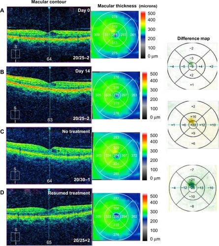 Figure 4 Optical coherence tomography studies for case 4 (diabetic retinopathy).