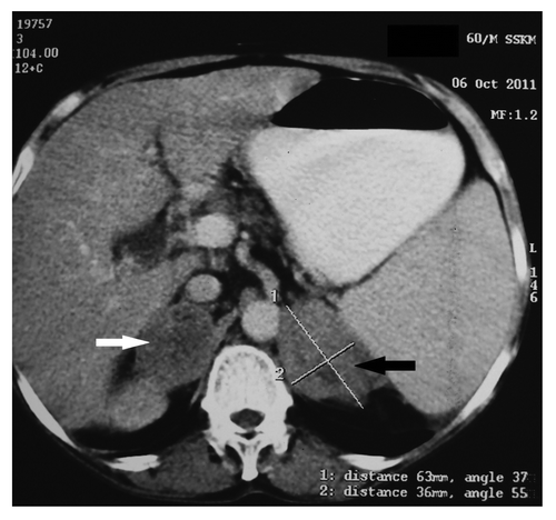 Figure 2. CT abdomen showing enlarged left (63 × 36 mm; black arrow) and right (49 mm × 33 mm; white arrow) adrenals with areas of necrosis.