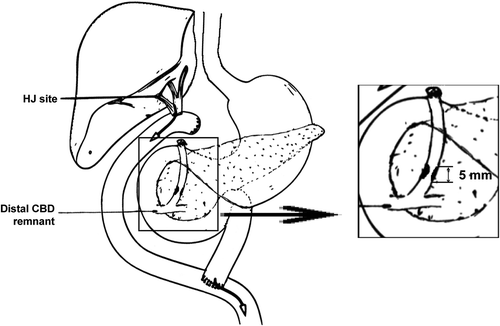Figure 2. Patient anatomy with CBD stricture