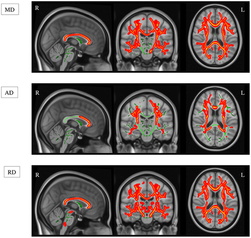 Figure 3 TBSS analysis showing significant differences in MD, AD, and RD between the group of patients with TBI and the healthy control group. The TBSS analysis revealed significant differences between the group of patients with TBI and the healthy control group. The mean FA skeleton, which represents the centers of main white matter tracts, is shown in green. Overlaid on the skeleton are the results of the statistical analysis. Red and yellow represent significant differences (red, p-value < 0.05; yellow, p-value < 0.01). The group of patients with TBI exhibited widespread increases in MD, AD, and RD compared with the healthy control group.